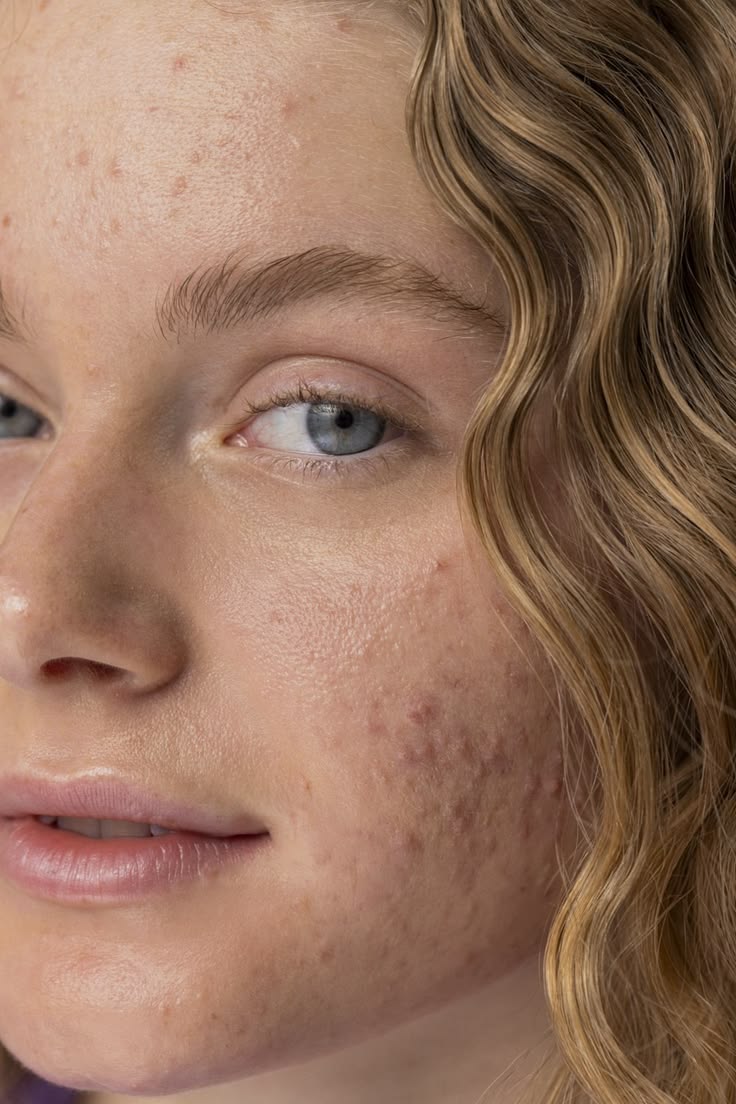Rostro con lesiones de acné en frente y mejilla