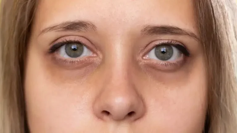 Mujer con ojeras oscuras bajo los ojos