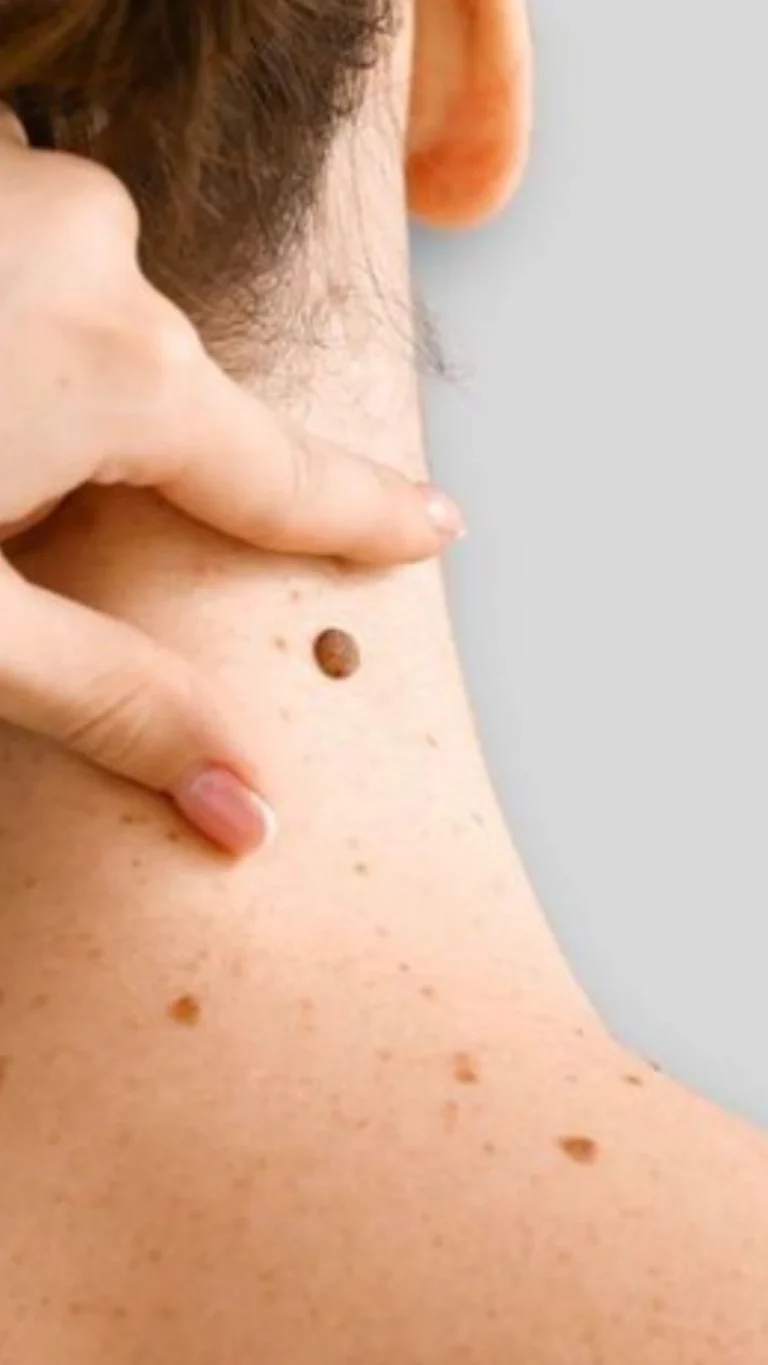 Persona señalando una lesión en la piel del cuello